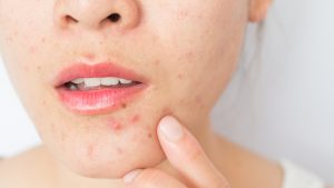 Dr Pimple Popper’s guide to the best way to pimple pop