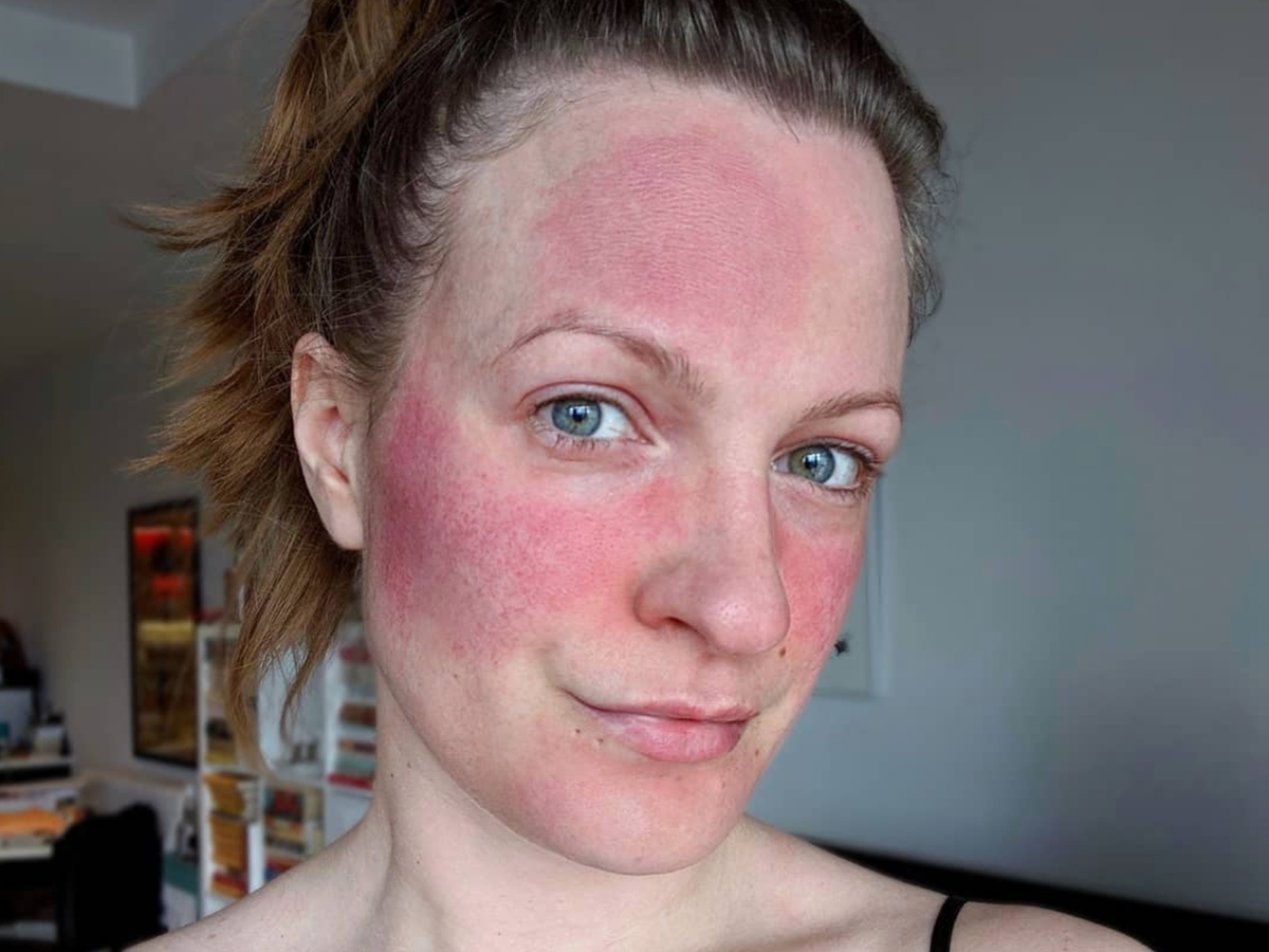 I Have Chronic Rosacea —  This Is The Only Skincare Routine That Helps